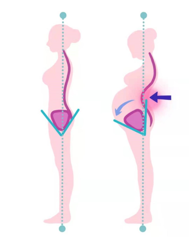 较真丨不止奚梦瑶,差不多一半的怀孕女性都会"脊椎错位"疼