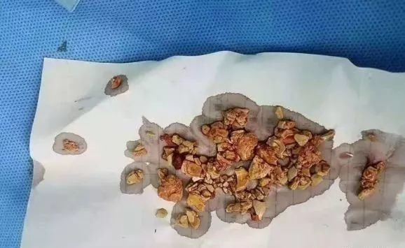 双肾小结晶 腾讯网