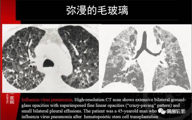 病毒性肺炎临床诊治进展―中国儿童咳喘全国巡讲贾晓周