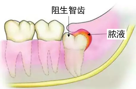 智齿冠周炎要引起足够重视,能拔除及早拔除