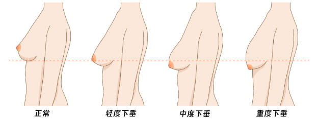 医生提醒:为什么有些女性乳房下垂,有人却"坚挺"?今天