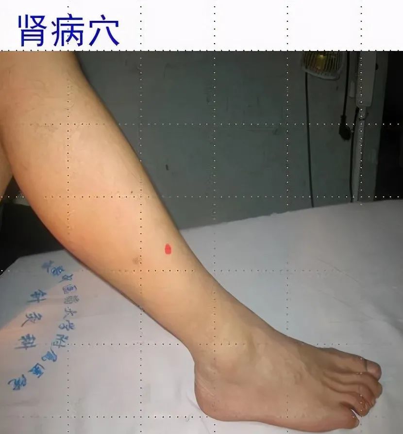 21,肾病穴 定位:位于外踝高点之上8厘米,腓骨内侧前缘,即腓骨小头至