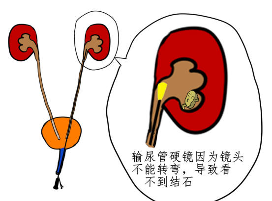 发现有肾结石,应该这么做(详细攻略版)