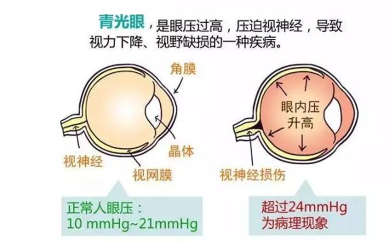 「科普」青光眼和白内障的区别,你分得清吗?