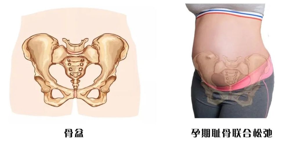 怀孕生孩子那些事之耻骨联合分离为什么会耻骨分离