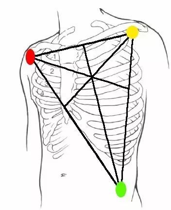 3 导联心电导线颜色标记为红,黄,绿或白,黑,红;5 导联心电导线颜色