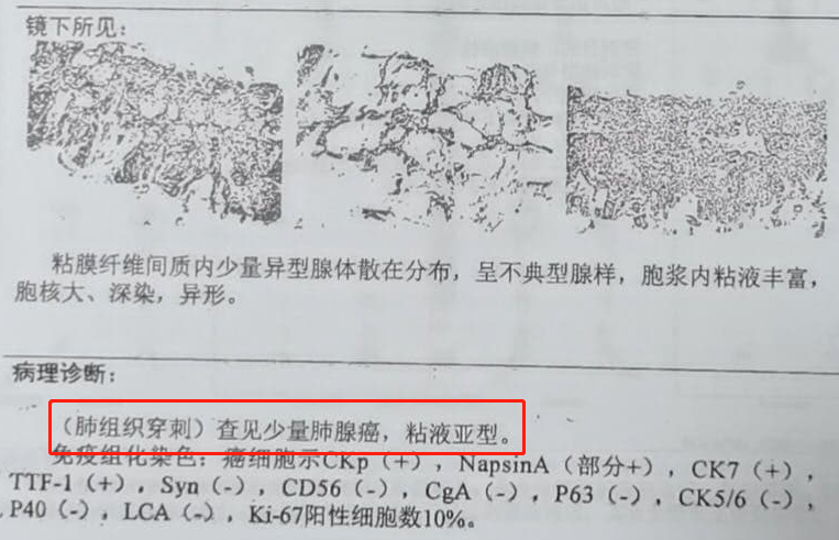 患者福音!80岁肺癌病人,抗癌1个月肿瘤明显缩小,在家就能治疗