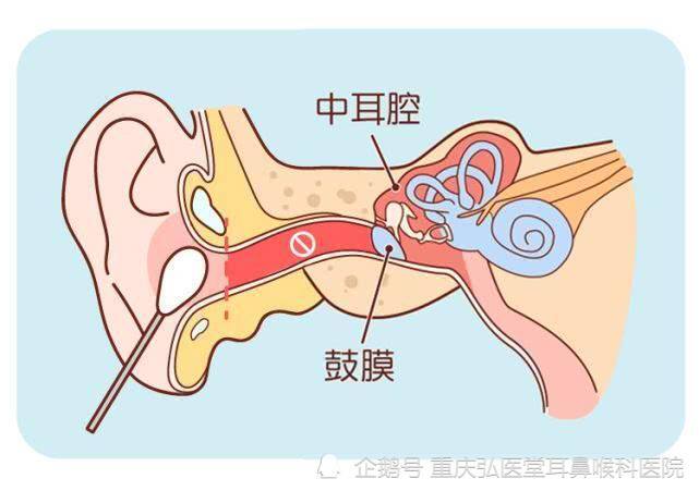 重庆弘医堂耳鼻喉医院分享:中耳乳突炎是怎么引起的