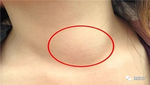 2,淋巴结核:比较常见的是在颈部的一侧或两侧长出肿块,逐渐长大,无