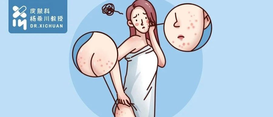 屁股上长痘是怎么回事?这4个地方长痘的真相,你早该知道了!