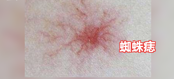 35岁男子皮肤出现"蜘蛛痣 发现时已肝癌晚期|乙肝|蜘蛛痣|肝癌晚期