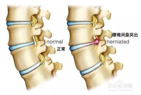 颈 胸 腰 椎间盘突出症成为医学上多个临床上人都是有亚健康状态的,放