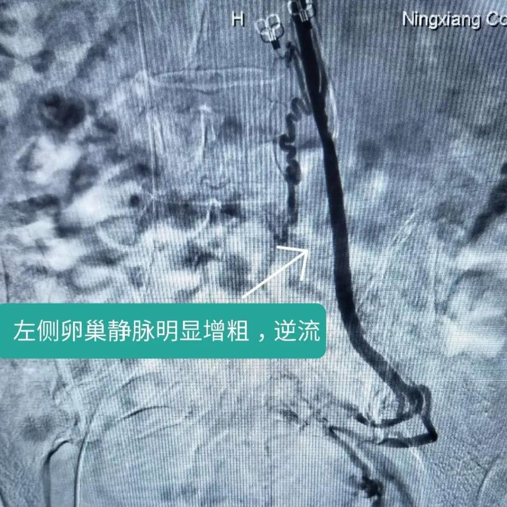 因盆腔静脉淤血综合症存在特殊的血流动力学特征,即卵巢静脉血流反向