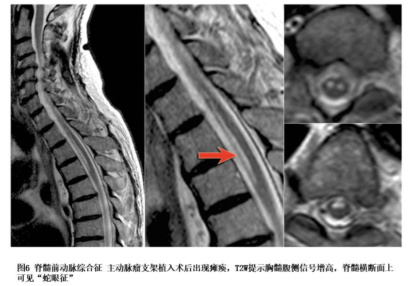 从1个病例出发,全面了解脊髓长节段病变的10大鉴别诊断