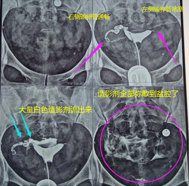 的走向,根据造影剂在输卵管及盆腔内的显影情况来了解输卵管是否通畅