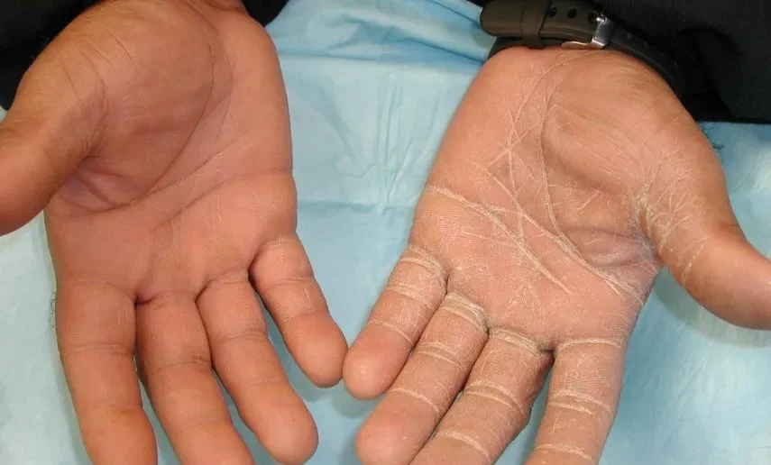 手癣,江湖俗称"鹅掌风",指的是手掌及手指间被皮肤癣菌感染,整个手看