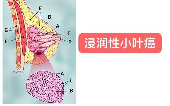 如图三所示,小叶癌是起源于乳腺小叶细胞,也就是产生乳汁的细胞.