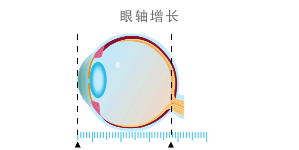 【预测近视】关于眼轴,你需要知道这些!