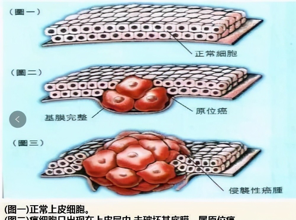 常见的原位癌其实是比较多的,比如皮肤的原位癌,胃原位癌,子宫颈原位