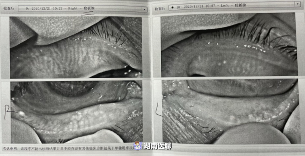 干眼症人口_干眼症症状图片(2)