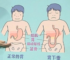 1,膈肌位置下降可能导致胃下垂