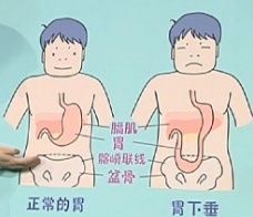 西安东大肛肠医院丨造成胃下垂的几个原因请当心了