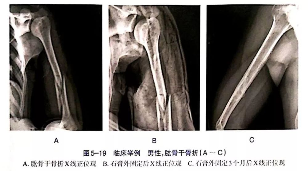 同时两手指拉远段断端向外,使骨折两端内侧平齐,且轻微向外成角