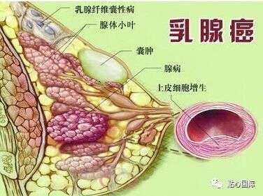 乳腺癌是女性最常见的恶性肿瘤,早期乳腺癌无明显症状,不易被发现,但