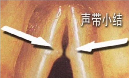 潍坊耳鼻喉医院声带小结与声带息肉有什么区别