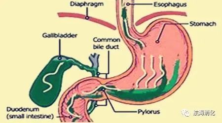 查出胆汁反流自我保健十要点
