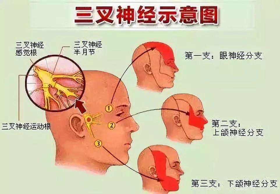 2/10万),在面部三叉神经分布区内反复发作的阵发性剧烈痛为主要表现.