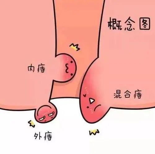 痔疮是肛肠科最常见的一种疾病,俗有"十人九痔"之说.