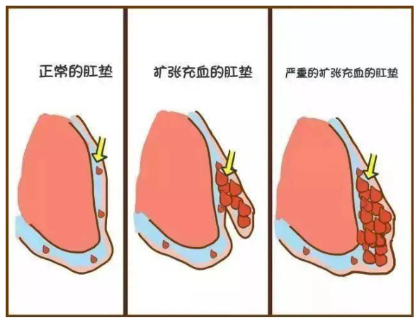 74Ⅳ度:痔核长期在肛门外无法还纳,或者还纳后立即再次脱出.