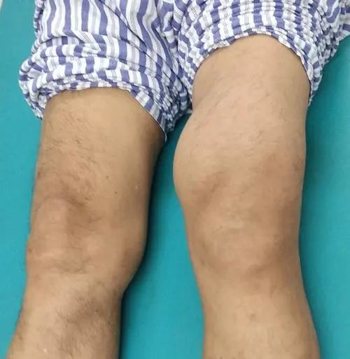 跖趾关节,膝关节次之,较少发生于其他关节 由于其起病隐匿,症状不典型