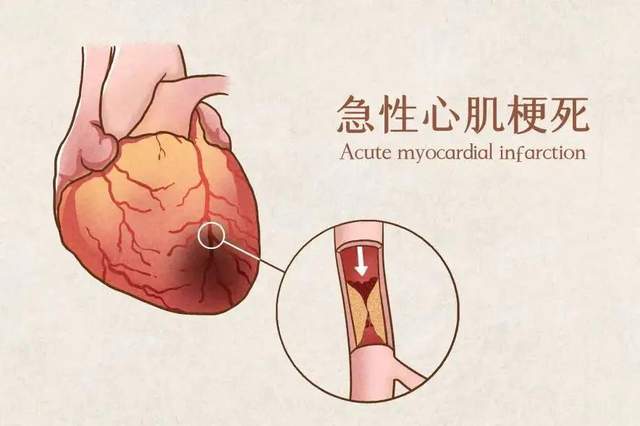 为什么心梗会缠上年轻人?