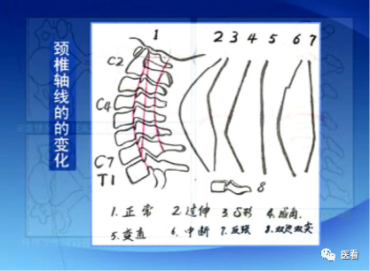 收藏丨手把手教你在x线上如何测量颈椎生理曲度变直