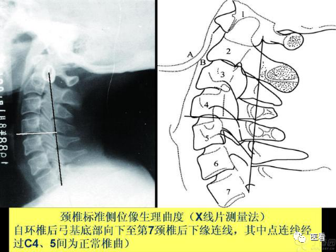 收藏丨手把手教你在x线上如何测量颈椎生理曲度变直