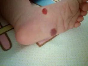 脚底血管瘤该如何治疗其实并不复杂前提要选对方法