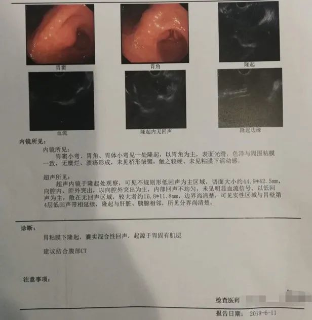 外科医生仔细看过胃镜结果后,我听到了一个从未听过的名词"间质瘤".