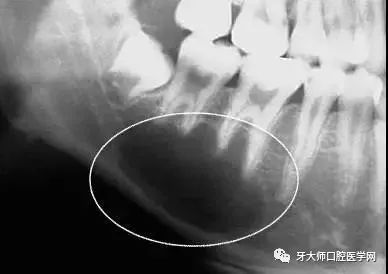 看牙还要拍片?医生直接治疗不就好吗?你不知道它有多重要!