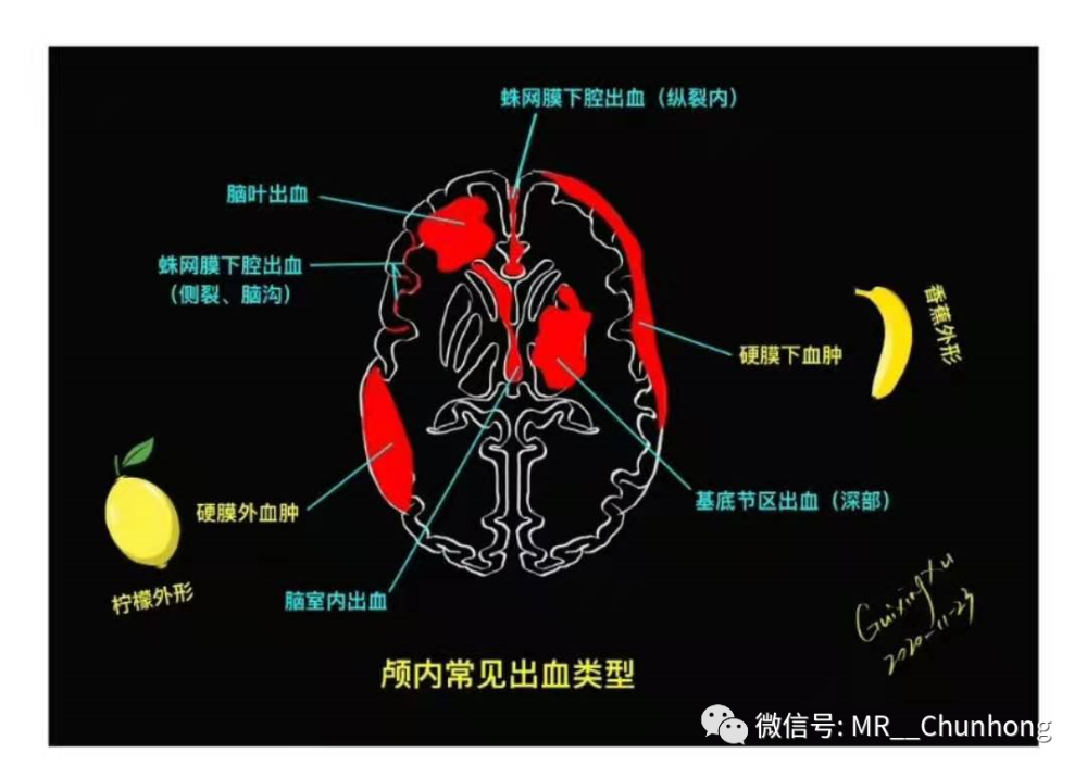 颅内出血最常见的有脑实质出血,蛛网膜下腔出血,硬膜下出血及硬膜外