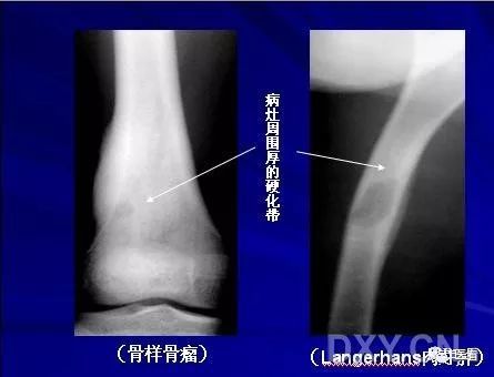 生长稍快的良性瘤,边缘清楚但无硬化,如巨细胞瘤,动脉瘤样骨囊肿;生长