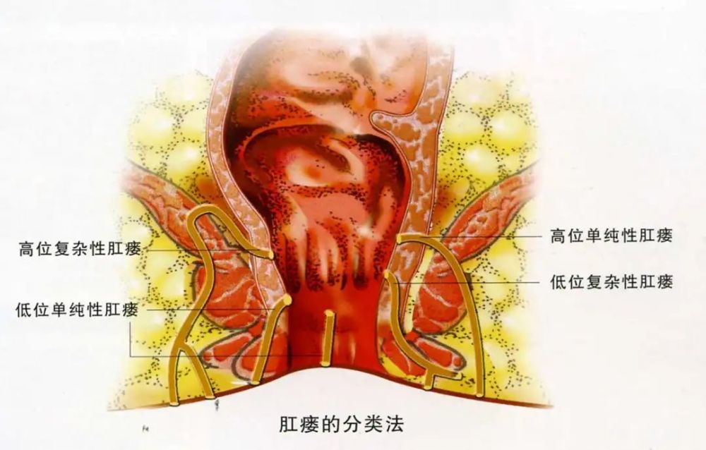 肛瘘如何分类?又有哪些需要进行手术治疗?