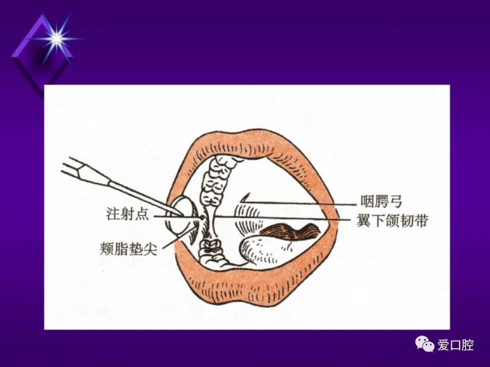 口腔科常用阻滞麻醉总结