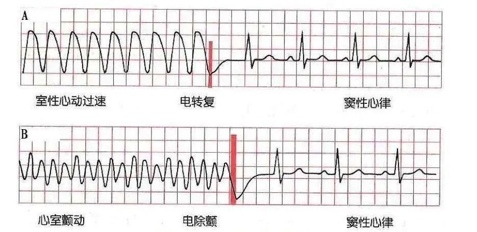 常见的室性心律失常心电图_腾讯新闻