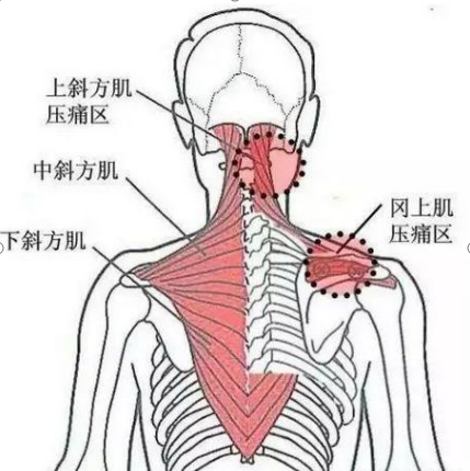 你所不知道的肌筋膜炎