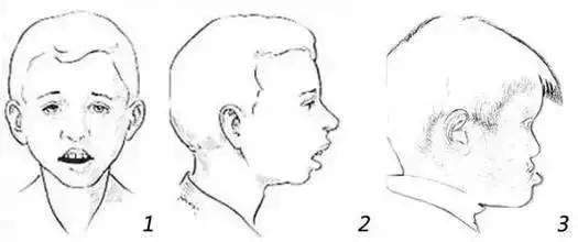 娃越长越丑,张嘴呼吸,警惕"腺样体面容"