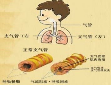 儿童新型多功能直肠栓小儿急性支气管炎的应用国家儿童医学中心贾晓周