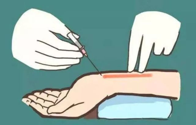 关于护理日常的动脉采血如何做到一针见血
