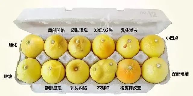 仅 1 % ~ 3 %的肿瘤跟遗传有关 *乳腺不是消化器官,表面上看乳腺癌